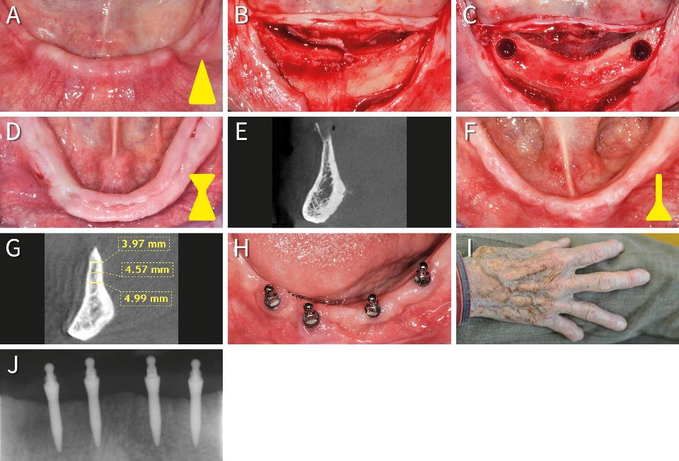 Fig. 15: The section shape of the interforaminal area can be assessed pre-operatively with palpation or CBCT. In crests with a triangular section type (A), the initially insufficient crestal width (B) can be increased by occlusal reduction (C). Such ostectomy is contraindicated in sandglass (D, E) or thin, parallel-shaped (F, G) anterior mandibles because it extends beyond the floor of the mouth. The latter cases may only be eligible for diameter-reduced or small-diameter implants. Clinical (H, I) and radiological (J) picture of 2.1-mm narrow implants after 3 years in function in the 97-year-old man