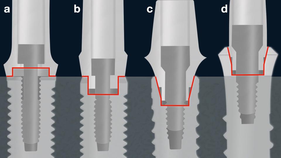 Fig. 11: Implant/abutment external (a), internal (b) and conical (c, d) connections. a, b, c: Bone level implants. d: Tissue level implant