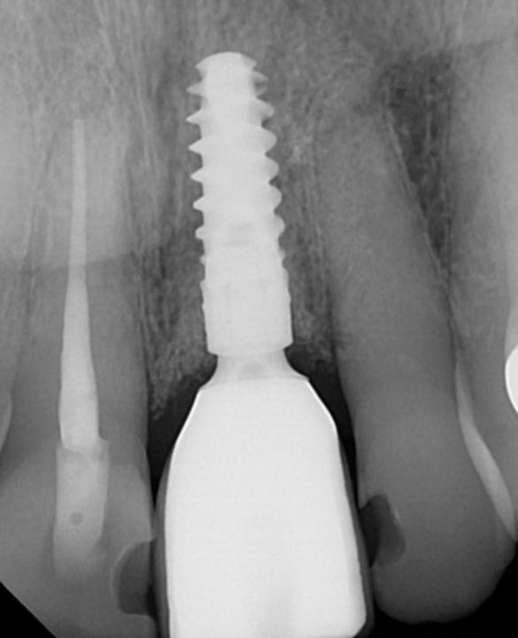 Fig. 9f: 1 year post-op radiograph