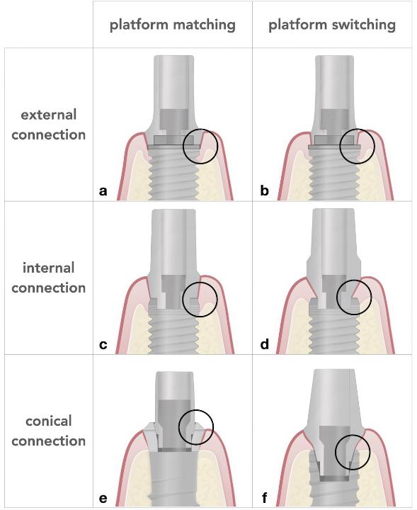 Fig. 13: Implant external (EC), internal (IC) and conical (CC) connections and platform matching (PM) or switch (PS) abutments. a: EC with a PM abutment, observe the bone resorption around the implant due to the proximity of the micro-gap/interface with the bone. b: using the same connection but with a PS abutment, observe the increased horizontal distance from the micro-gap, reducing the marginal bone loss. c: An internal parallel wall connection with a PM abutment, observe the reduced bone loss when compared to EH and PM. d: IC and PS, the horizontal shift of the micro-gap and more stable bone. e: CC with PM, but in this case, the tissue level implant shifts the micro-gap/interface vertically to the soft tissue, observe the minimal bone loss. f: CC with PS in a bone level implant, showing minimal bone alterations