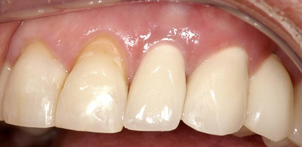 Fig. 15a: Final restorations 2 years post-op show excellent esthetics and tissue stability with full inter-implant papilla