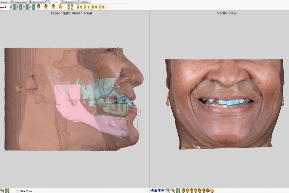 Fig. 20: A digital diagnostic tooth arrangement can be superimposed to the virtual patient to simulate soft tissue profile changes and obtain the patient’s approval