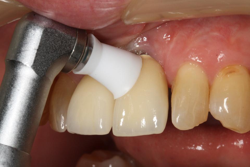 Fig. 7f: Supportive peri-implant care protocols should be individually tailored for each patient and may include professional mechanical plaque removal using a rubber prophylaxis cup