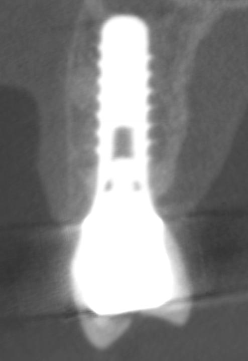 Fig. 6f: The oro-facial cut confirms a fully intact buccal bone wall of roughly 2 mm thickness