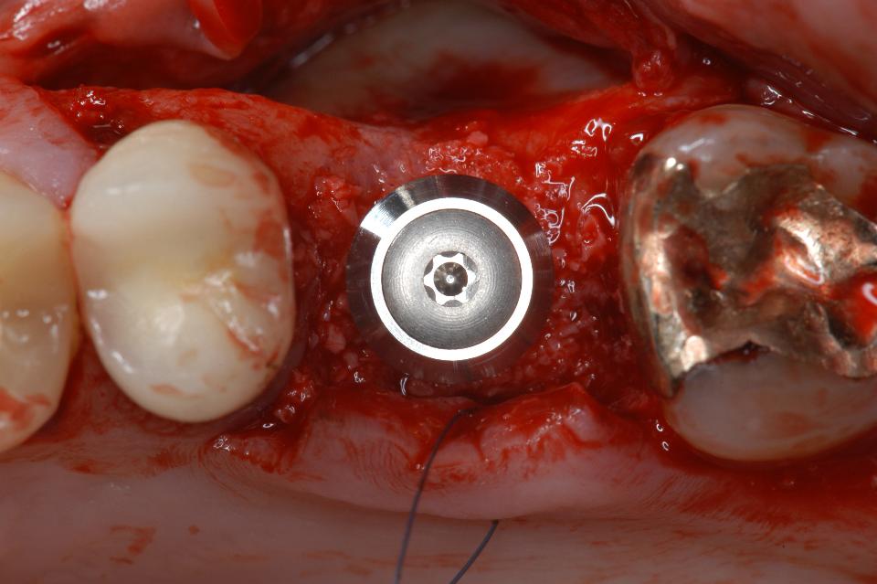 Fig. 8g: Status following insertion of a Wide Neck implant, fitting well into this first molar site