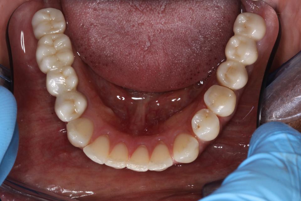 Fig. 7c: Prosthetic restoration with monolithic full-zirconia crowns