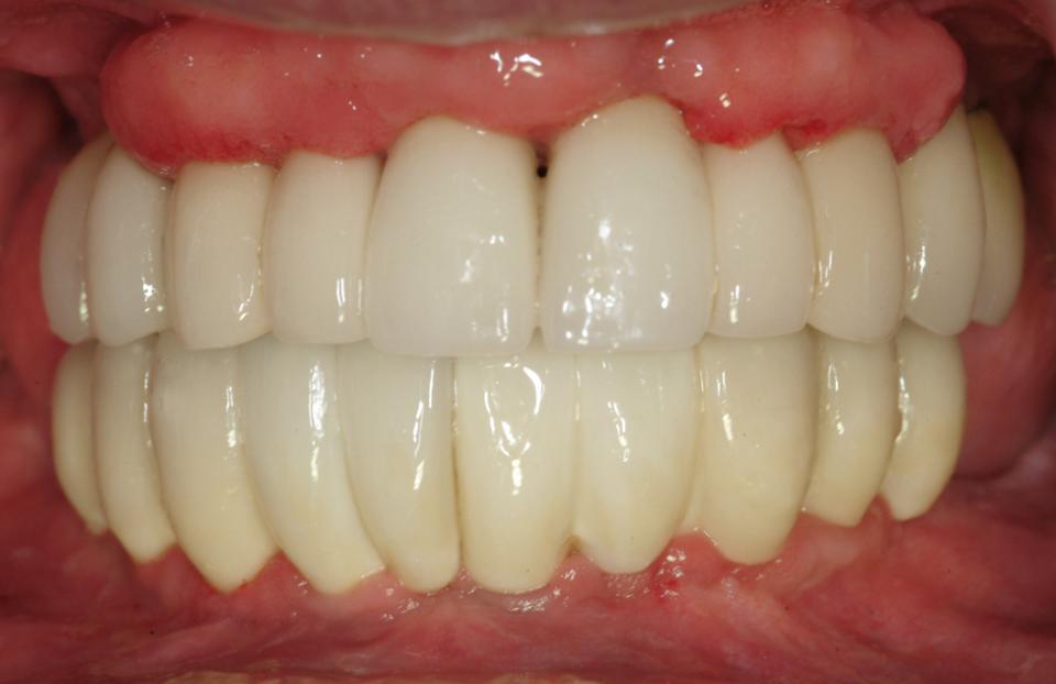 Fig. 4b: Intraoral photograph of implant prostheses taken at the 11-year follow-up. Note the hypertrophic and inflamed condition of the peri-implant mucosa