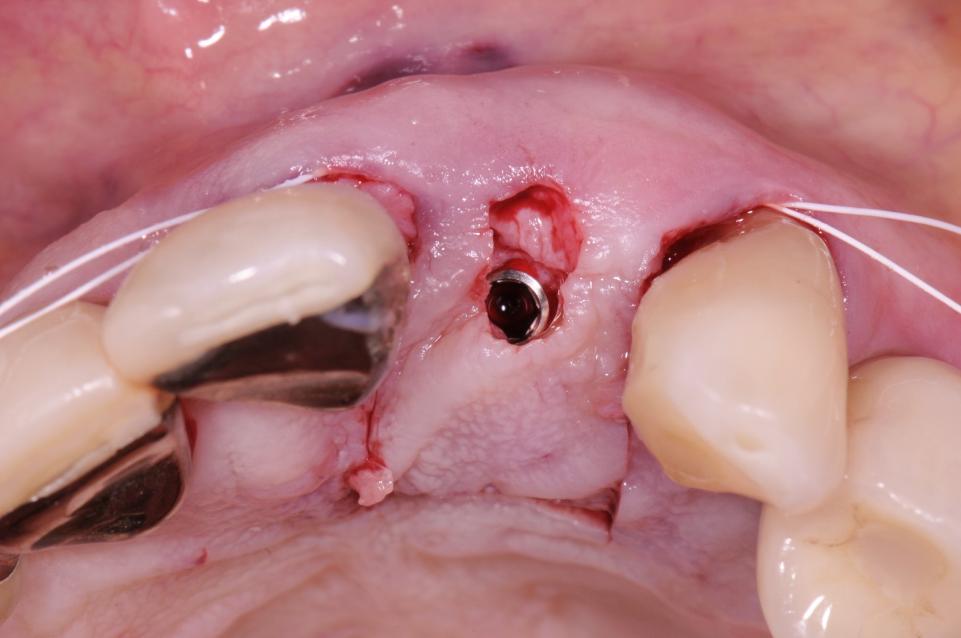 Fig. 17: When higher amounts of tissue are needed, a connective tissue graft can be placed using a tunneling technique and a palatal island flap
