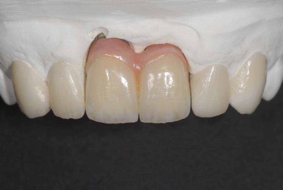 Fig. 5d: In order to achieve a more harmonious and balanced whole, the treatment plan comprised the fabrication of two new implant crowns. To allow the adequate implementation of pink ceramics, the new crowns had to be splinted. After carrying out a clinical “mock-up” trial, it was decided to improve the volume, form and length of the adjacent maxillary anterior teeth with minimally invasive adhesive porcelain restorations