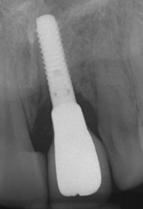 Fig. 3f: The postoperative peri-apical radiograph confirms stable bony conditions adjacent to the NNC soft tissue level implant, including the characteristic remodeling and saucer-like crater formation