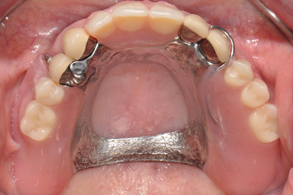 Fig. 48: Intraoral view of CAD/CAM implant-retained removable partial dental prosthesis