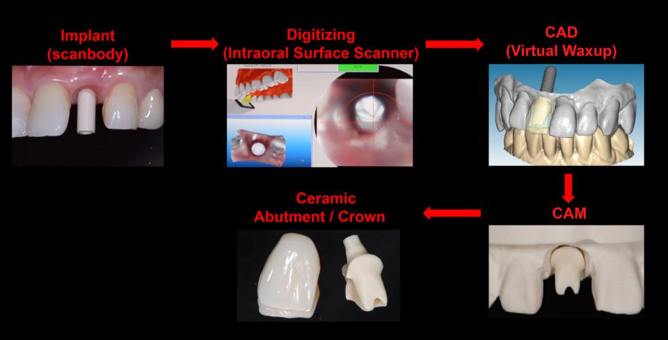 Fig. 2: Digital workflow of implant restorations