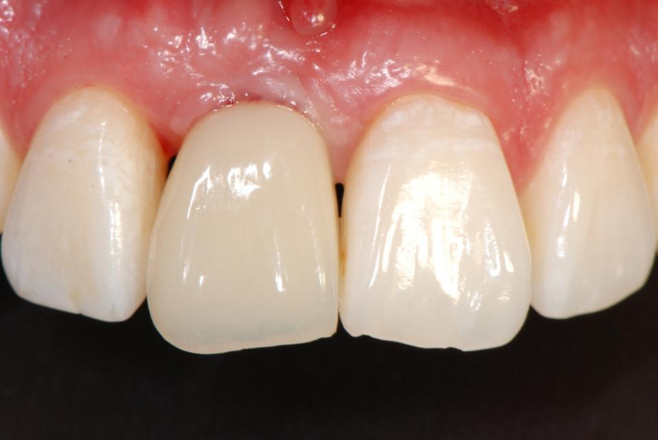 Fig. 4: Provisionalization and peri-implant soft tissue contouring