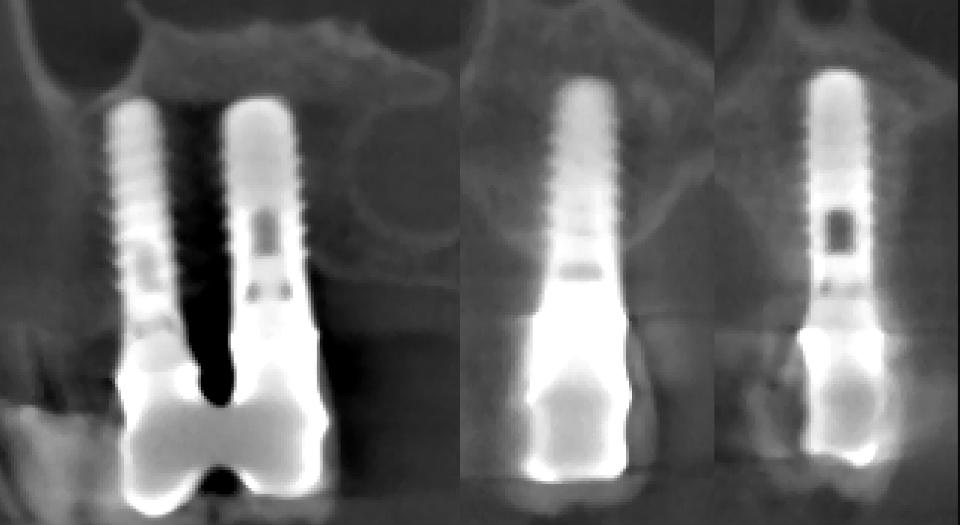 Fig. 7d: The CBCT shows an excellent peri-implant bone volume in the area of the former bone atrophy, and an intact buccal bone wall
