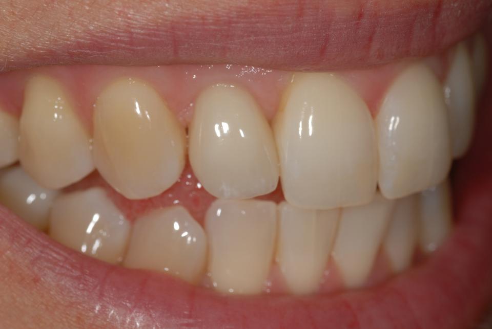 Fig. 2e: The patient’s unforced smile documents an acceptable degree of esthetic integration of the implant restoration, despite the presence of a so-called “gummy smile”