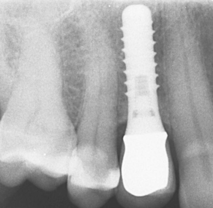 Fig. 6d: The peri-apical radiograph shows excellent stability of the crestal bone around the tissue level implant with a machined implant surface in the neck region