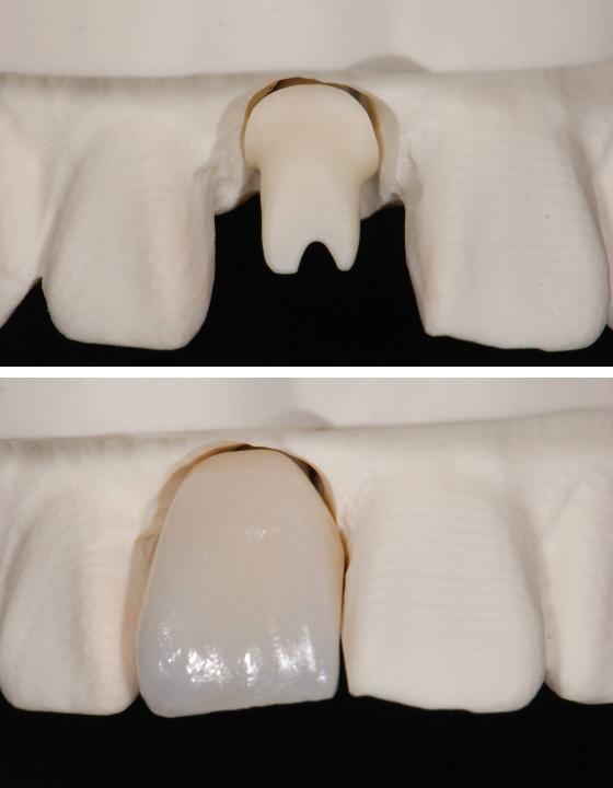 Fig. 8: Fabrication of a milled master model, all-ceramic abutment and crown