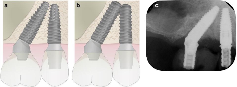 Fig. 5: Inter-implant spacing with tilted implants is more difficult with cylindrical implants compared to tapered implants and can result in apical collisions unless shorter implants are used, which may reduce primary stability. a: Close approximation of the apices of tapered implants. b: collision of the apices of cylindrical implants of the same size. c: Example of placement using guided surgery with apices in close approximation