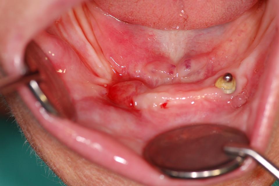 Fig. 13a: Implant-related sequestration/MRONJ occurred at mandibular tissue level implant for implant overdenture after some years of function. Clinical situation after resection of necrotic bone with dental implant