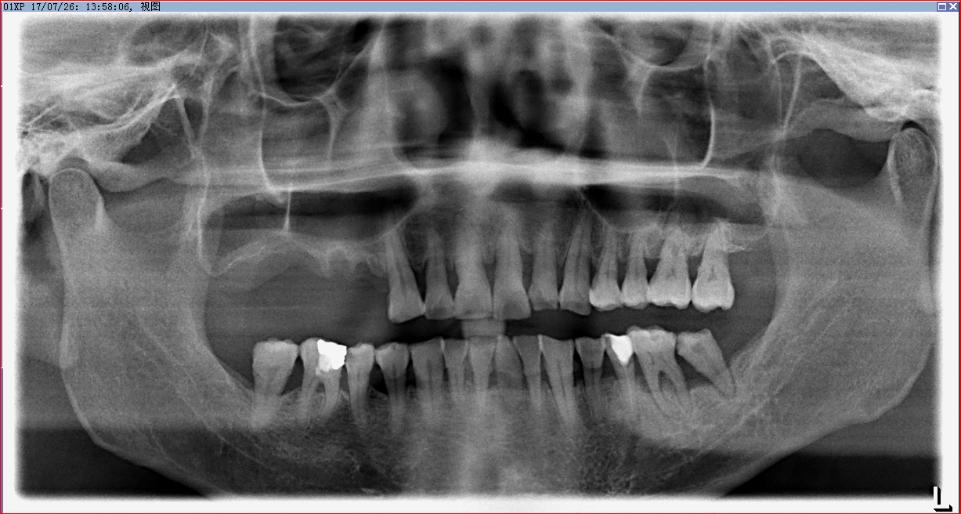 Fig. 6a: Pre-operative panoramic radiograph showing the presence of septa inside the right sinus
