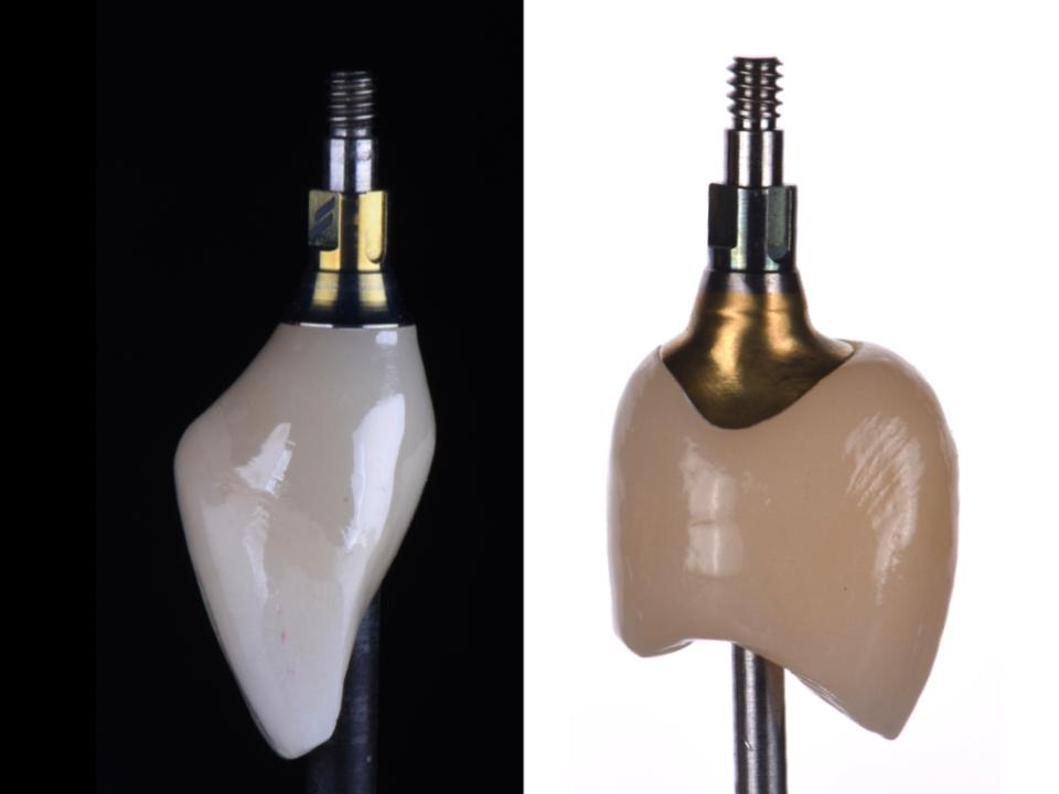 Abb. 3: Verschraubte implantatgetragene Krone mit vorgefertigtem Abutment (links) versus maßgefertigtem Abutment (rechts)