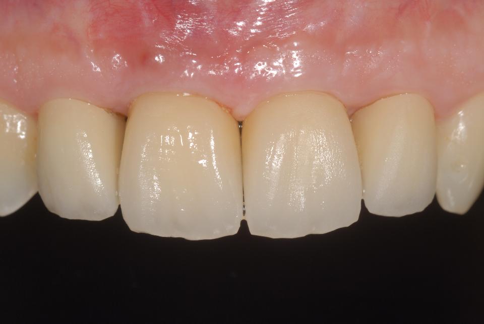 Fig. 6o: During the clinical bisque bake try-in, the need for minute modifications in color, form and volume can be identified and photographically documented for efficient communication with the dental ceramist