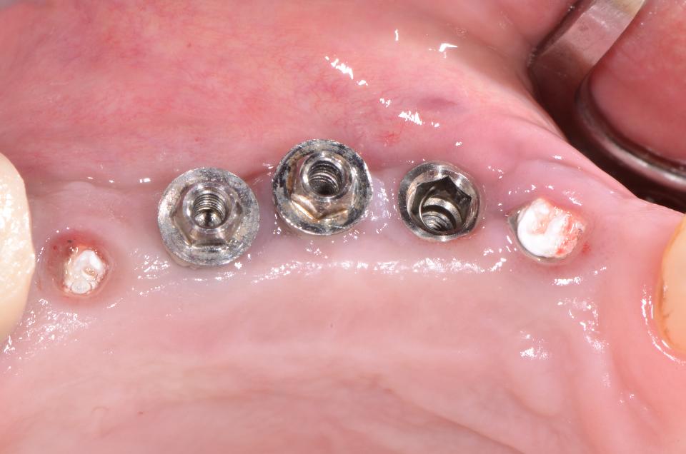 Fig. 11f: In order to offer the patient the comfort of an implant-supported FDP throughout the entire treatment period, it was decided in a first phase to remove only implants 14, 15 and 16. As a consequence, implants 13 and 17 were kept at this stage. During the following implant removal procedure, the screw-access was blocked-out with Teflon® plugs