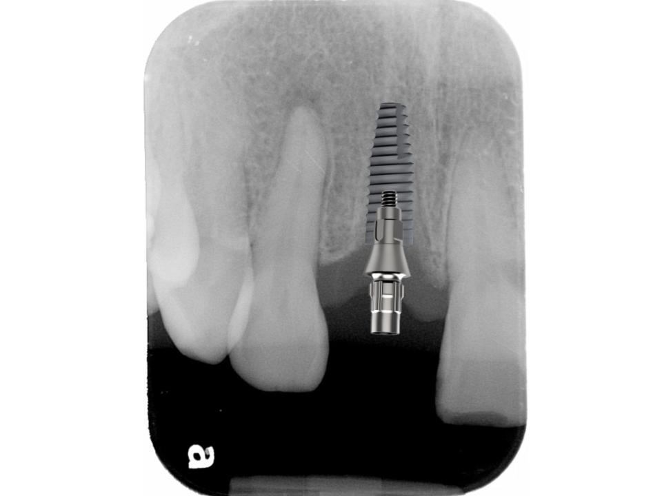 Fig. 4b: L'épaulement implant-pilier de la base en Ti pour les implants à connexion conique au niveau de l'os doit être situé à une distance suffisante de l'os et sous-muqueux, avec suffisamment d'espace pour un profil d'émergence optimal.