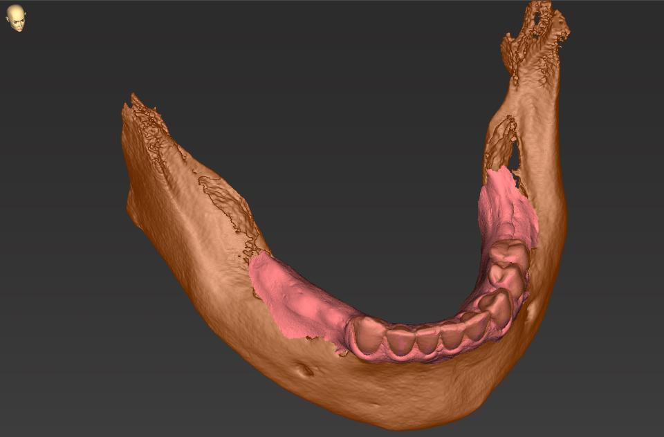 Fig. 2c: CBCT and IOS superimposed