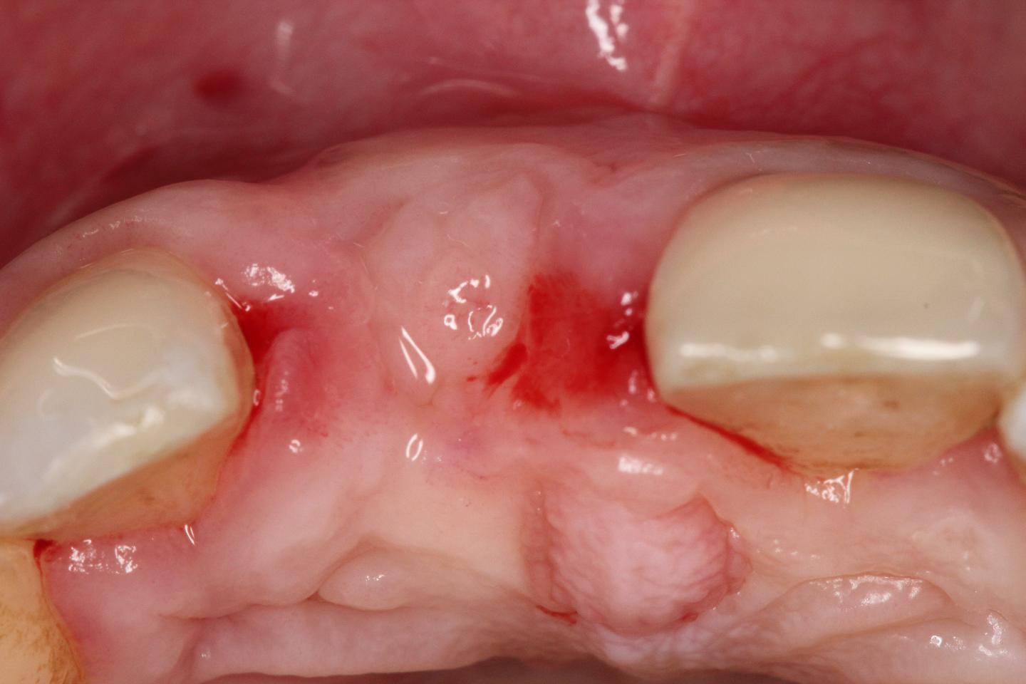 Articles - Forum Implantologicum - ITI