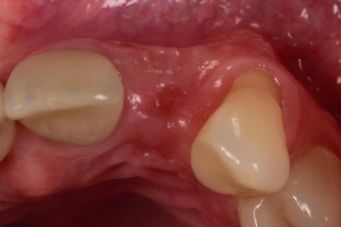 Articles - Forum Implantologicum - ITI