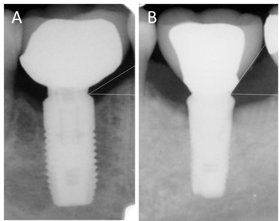 Fig. 6: Abutment contours may influence access to implants for hygiene. A) representation of a relatively oblique angled/concave contour abutment for a molar implant crown. It may be challenging to probe the implant effectively upon evaluation or manage biofilm on the abutment or implant itself. This mesiodistal representation may also reflect access from buccal or lingual aspects. B) representation of a relatively modest angled/convex contoured abutment supporting a molar implant crown. Access for probing or hygiene may be improved when compared with (A)
