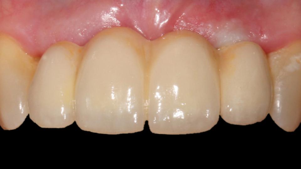 Fig. 3b: This intraoral photograph demonstrates that the esthetics, while acceptable, will not permit access to the implant abutments nor to the intaglio surface of the prosthesis for hygiene