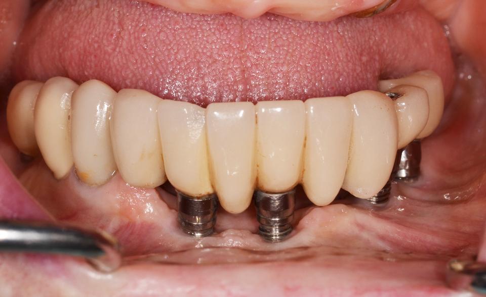 Fig. 5b: Intraoral photograph of implant-supported PFM prosthesis at 25 years following placement. Note that, despite tissue recession, there is a clinical absence of signs of inflammation and hypertrophy