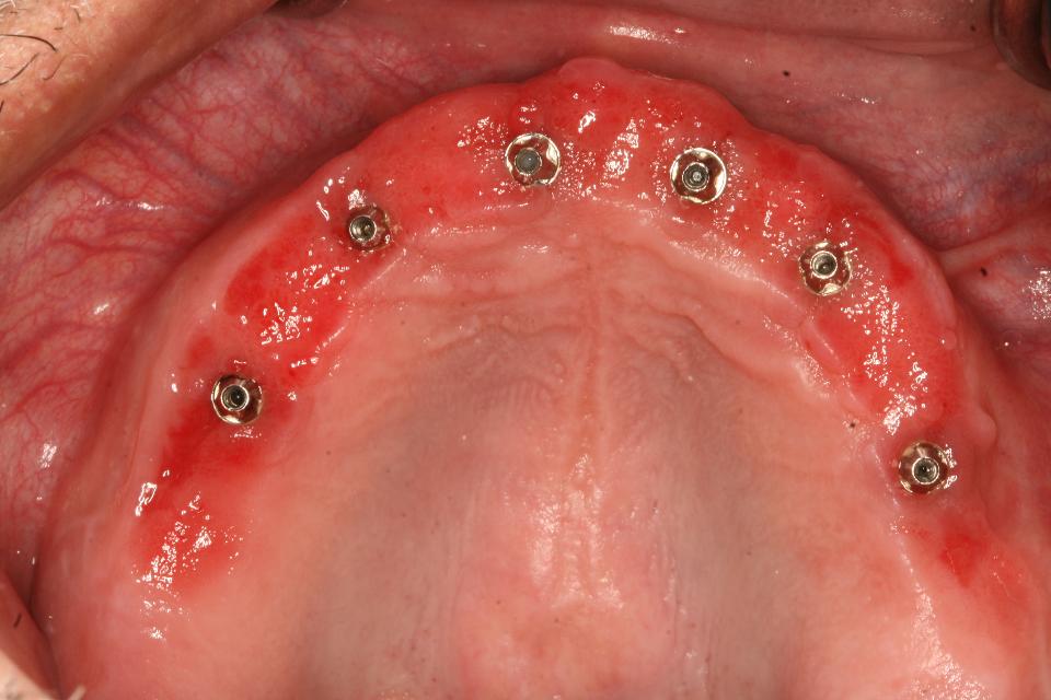 Fig. 1d: The related intraoral photograph demonstrates the peri-implant mucositis and generalized inflammation that results even after short periods of function. Maintaining this requires removal of the prosthesis for 3 - 6 months, supportive implant therapy involving removal of the dysbiotic biofilm and evaluation of the implants by probing. Modification of the intaglio surface of the prosthesis may be considered to enhance oral hygiene
