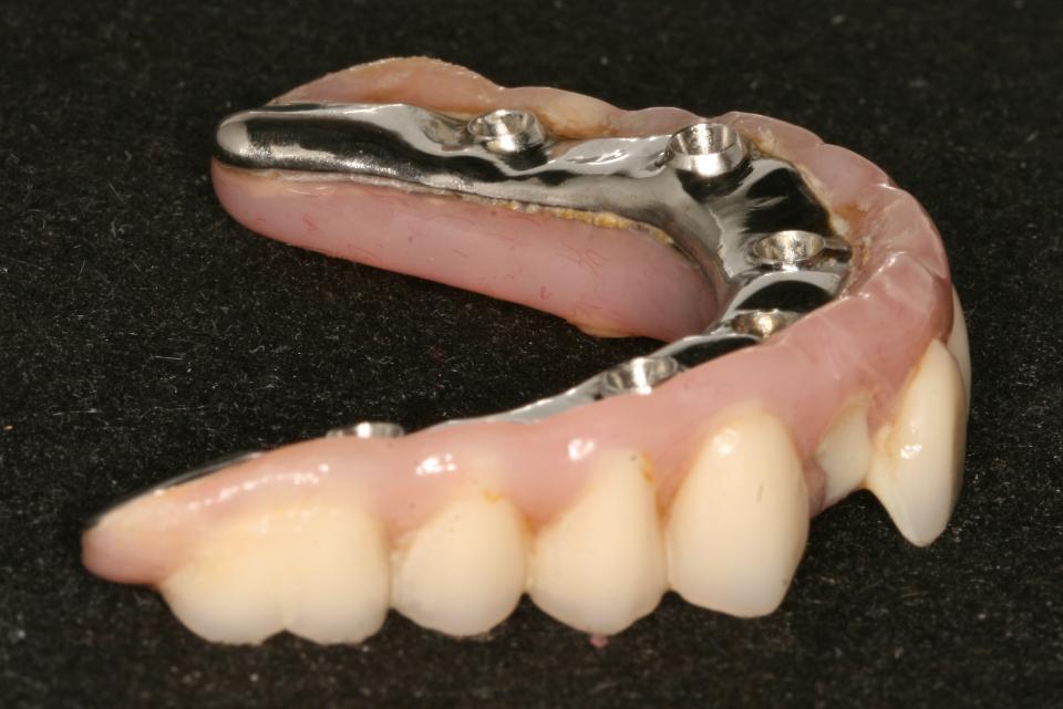 Fig. 1c: This maxillary metal acrylic prosthesis has a buccal flange that allowed the clinician to place cervical margins of crowns apical or parallel to the implant/abutment interface, but precludes access for oral hygiene