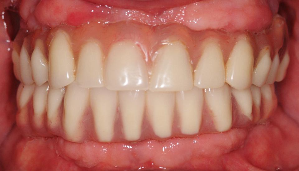 Fig. 5a: Intraoral photograph of implant-supported metal acrylic prostheses at 5 years following placement. Note that there is no visible space to gain access to intaglio surfaces or abutments for oral hygiene. Hypertrophic, fibrotic tissue is visible in the mandible while hypertrophic inflamed tissue is seen in the maxillary arch. The absence of restorative space has made this prosthesis design unhygienic
