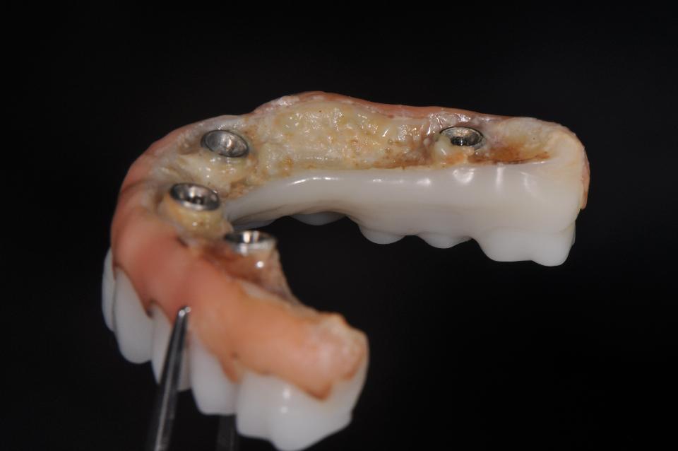 Fig. 1a: The intaglio surface of this full arch implant-supported zirconia prosthesis is concave and is bounded by flanges that preclude oral hygiene. Beneath the debris is a tenacious, dysbiotic biofilm