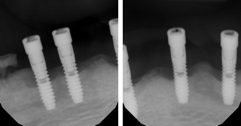 Figs. 2b - c: The peri-apical radiographs demonstrate the significant bone loss that has occurred around these implants and other distal implants supporting this prosthesis (Courtesy of Dr. Clark Stanford)