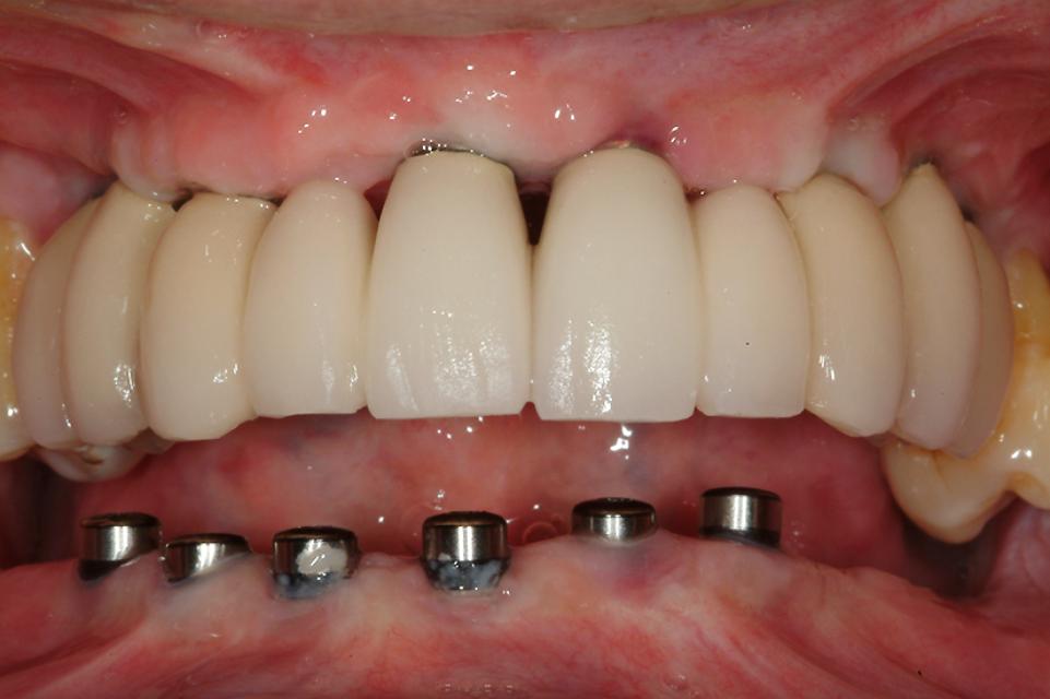 Fig. 4a: Intraoral photograph taken at ceramic try-in of maxillary implant prosthesis. Note condition and location of peri-implant mucosa