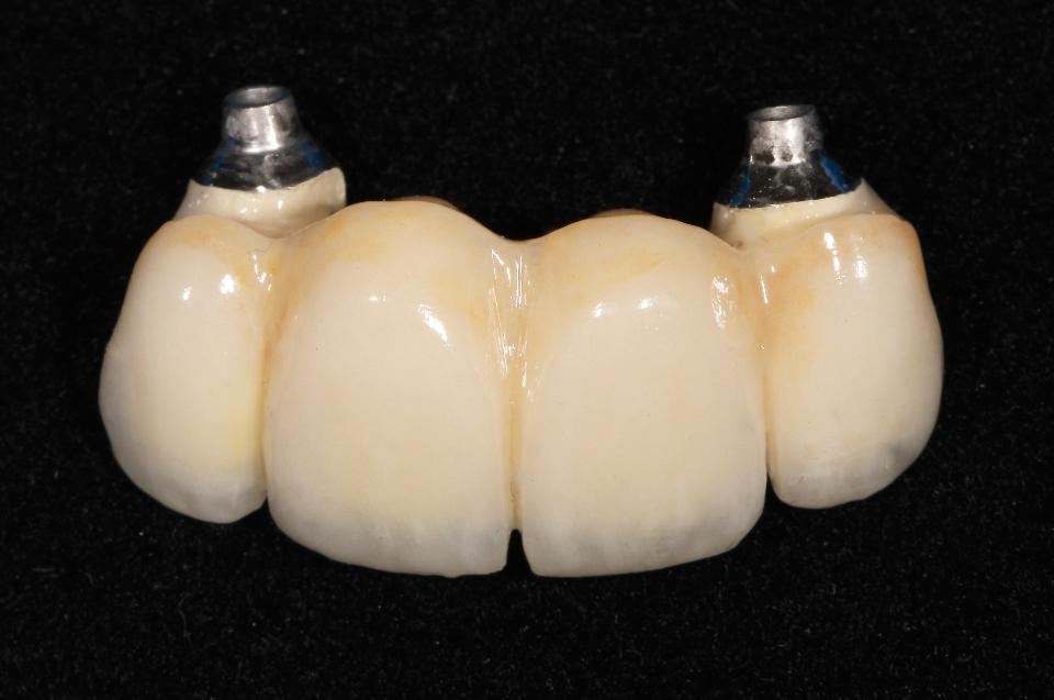 Fig. 3a: This four-unit fixed dental prosthesis demonstrates the complication presented when esthetic demands overshadow shallow implant placement. The situation required ridge lap design to place the crown margins beyond the alveolar crest