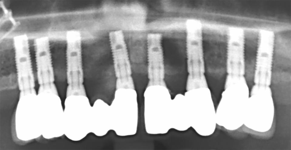 Fig. 4e: The radiograph taken at the 11-year follow-up indicates overall bone health, however, modest bone loss is evident at the implants demonstrating close proximity (1 mm or less). Implants positioned in close proximity challenge the oral hygiene efforts required for long term implant maintenance (far right)