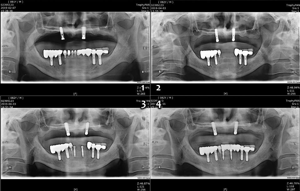 Abb. 10j: Magnetische Oberkieferdeckprothese auf 2 Implantaten (1–2) und 6 Implantate im Unterkiefer mit einer festsitzenden mehrteiligen Prothese (3–4). Auf den regelmäßig angefertigten Panoramaaufnahmen war seit 2007 an den beiden Implantaten (TL, Ti, SLA, Straumann) im Oberkiefer und den 4 Implantaten (TL, Ti, SLA, Straumann) in beiden unteren Seitenzahnbereichen sowie seit 2019 an den beiden Implantaten (BLT, 2,9 x 12, NC, Roxolid, SLActive, Straumann) im unteren Frontzahnbereich keine krestale Knochenresorption nachweisbar.