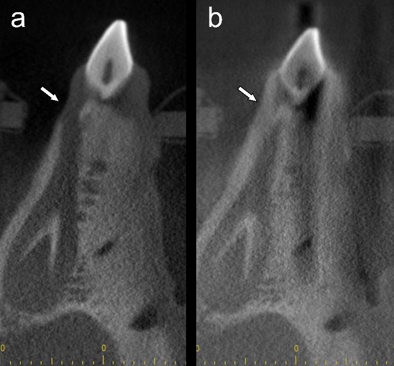 Fig. 7: Coupe transversale d’une mandibule de porc en tomographie à faisceau conique à petit champ, avec (a) et sans (b) un implant métallique dans l’exomasse. Les flèches blanches indiquent l’augmentation de luminosité des tissus mous dans la région cervicale, qui masque le canal gubernaculaire.