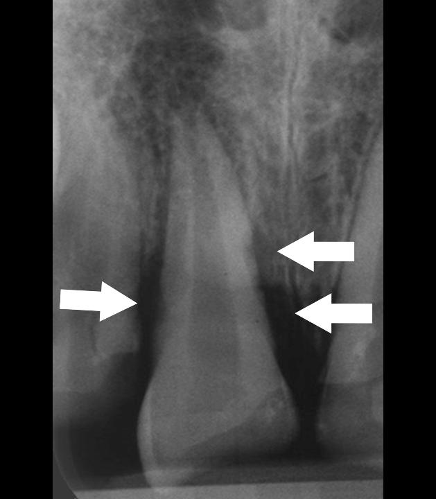 Fig. 2: Infection-related resorption. Periapical radiograph of a right central maxillary incisor. On the mesial and distal aspects of the root surface irregularities can be observed with corresponding radiolucencies in the alveolar bone