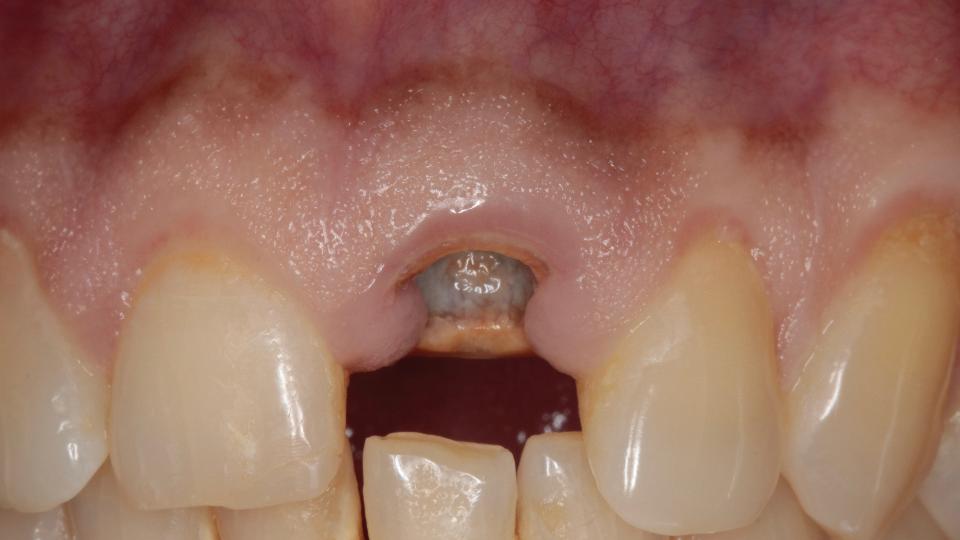 Fig. 3a: Minimally invasive technique for flapless tooth extraction – frontal view at baseline