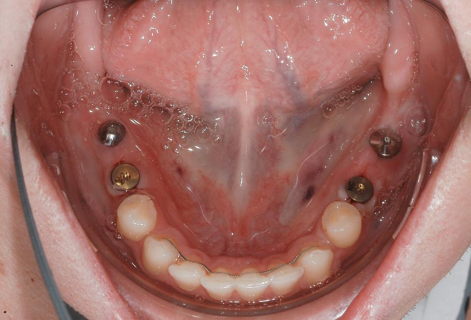 图4c: 种植体植入后的临床状况：下颌合面照