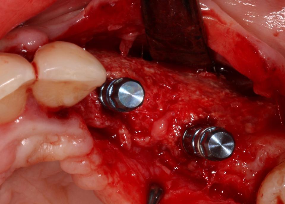 Fig. 7: Implants dont l'épaisseur de la paroi osseuse buccale est suffisante pour éviter une augmentation osseuse supplémentaire. La situation clinique a permis la mise en place d'implants de diamètre réduit, ce qui a encore amélioré l'épaisseur de la paroi osseuse buccale après l'opération.
