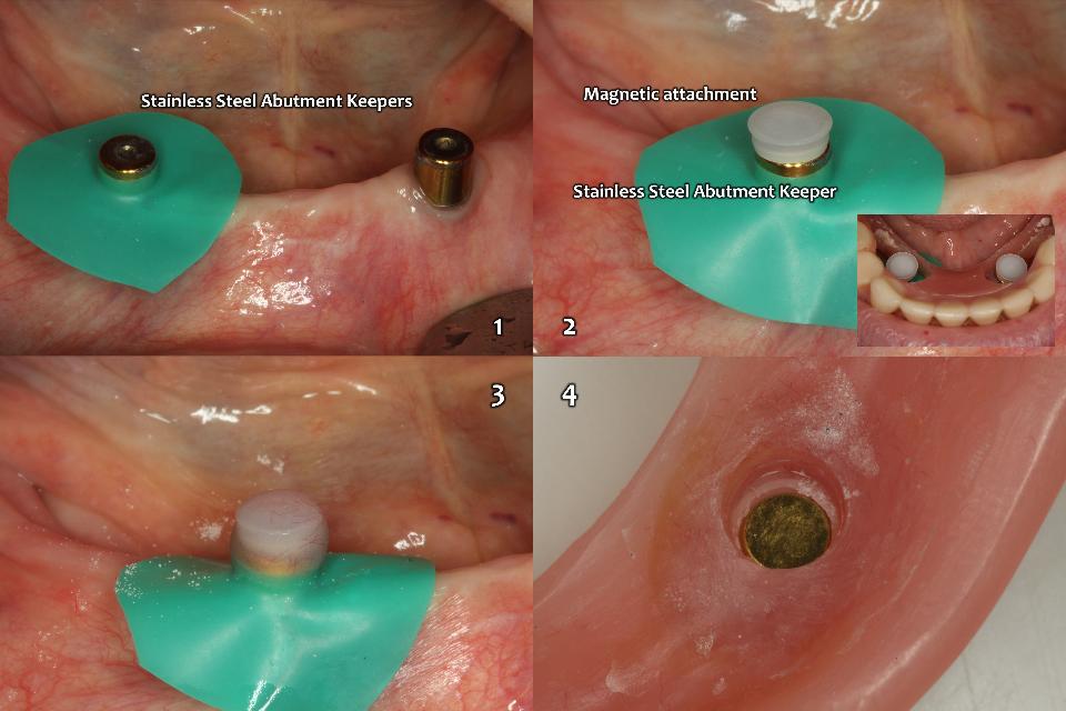 Fig. 14a: Treatment options as the 3rd priority (Fig. 5). 2-implant retained overdenture can be provided as the patient-friendly treatment option for the lower edentulous jaw with the flexible type of magnetic attachment (Magfit-SX800, Aiichi Steel,). 1: insert abutment keepers with 25Ncm fastening torque and place the rubber dam block out; 2: place the magnetic attachment on the abutment keeper; 3: initial coating the combination (2) with self-curing acrylic resin; and 4: completed cementation of Magfit-SX800 on the denture which can move 0.4 mm up and down while maintaining a magnetic force of 800 gf, and also slightly rotate and twist