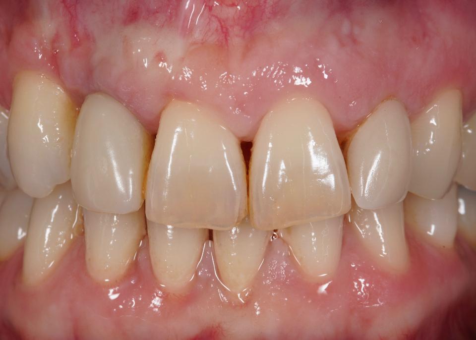 図15: 図14に示した欠損を管理するために、歯冠側移動術をともなう結合組織移植を行った術後像。歯肉－歯槽粘膜境が再確立され、審美性が著しく改善されている